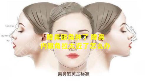 隆鼻眼角肿了 隆鼻内眼角拉太近了怎么办